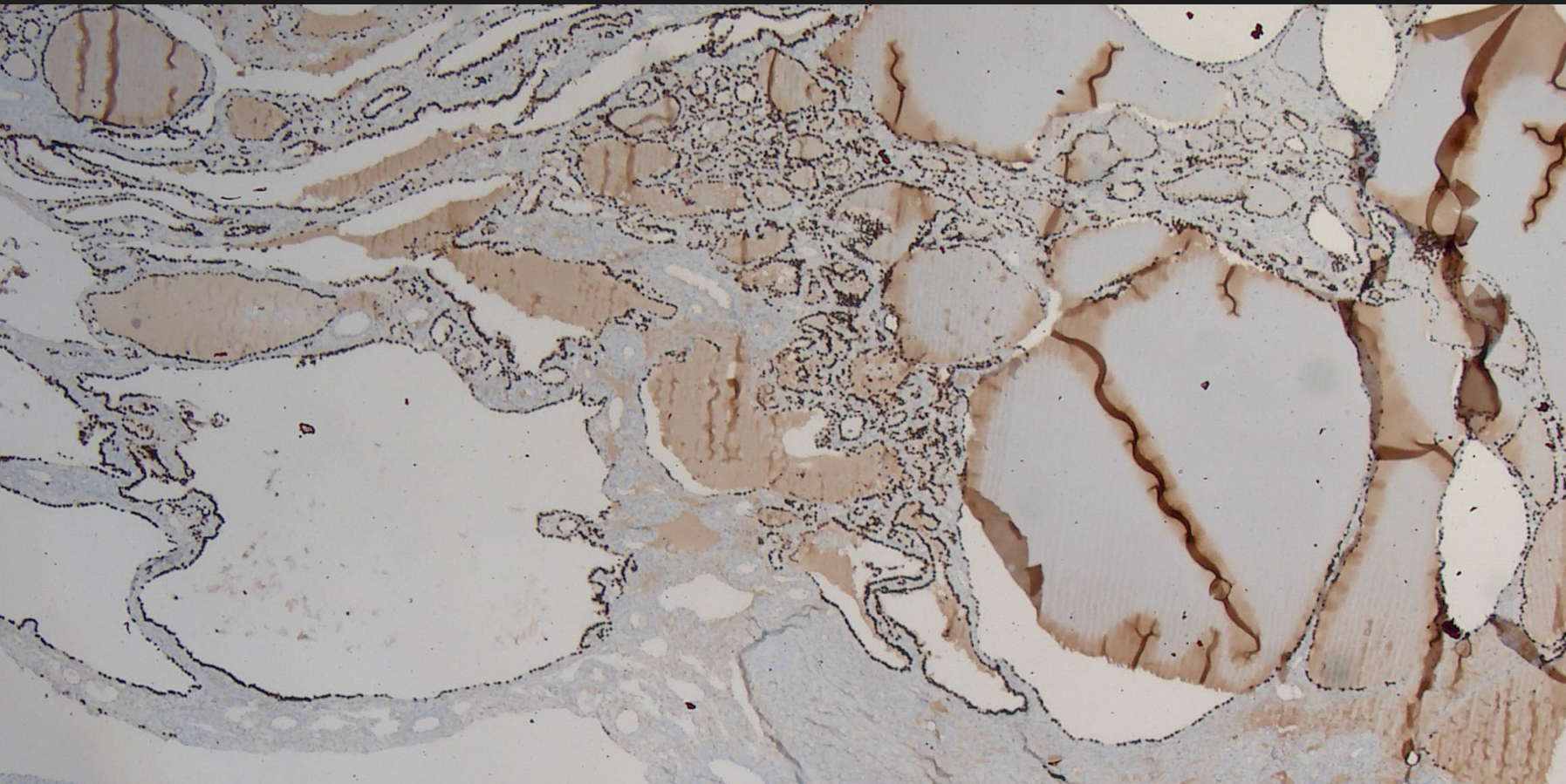 Colloid filled follicles of varying sizes lined by cuboidal epithelium which shows diffuse strong nuclear positivity for TTF-1