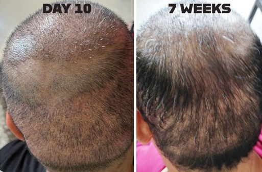 Image of the patient showing acute donor effluvium on 10th day and after 7 weeks of transplant. (attached separately)