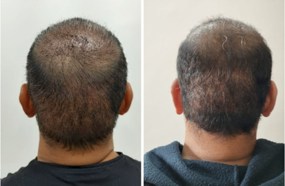 Image of the patient showing appreciable recovery within 3 monthspost transplant. (attached separately)
