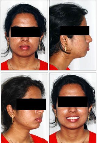 Pre-treatment extra-oral photos