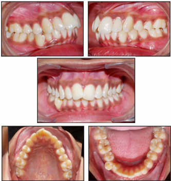 Pre-treatment intra-oral photos