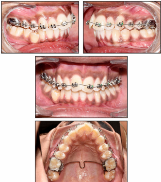 Upper arch bonding with low-lying transpalatal arch 