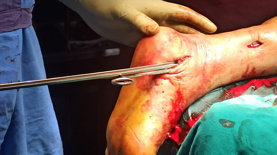 Showing intraoperative extraction of K-nail