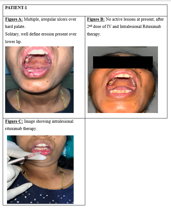 Efficacy of Low-Dose Intravenous and Intralesional Rituximab in Oral Pemphigus Vulgaris: A Novel Treatment Protocol (Dr Badad’s Protocol)