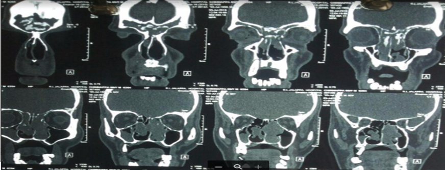 Computerised Tomography scan showing the extent of the tumor