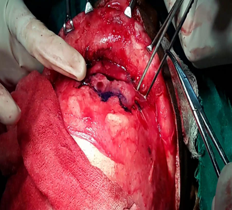 Template marking for bone flap elevation