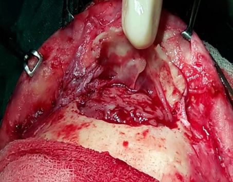 Osteoplastic bone flap elevated based on pericranium and tumor visualized in the frontal sinus