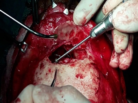 Drilling of walls of frontal sinus