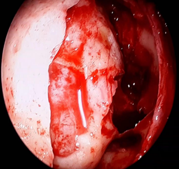 View of Draf III from cranial end