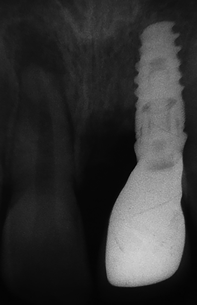 Periapical radiograph