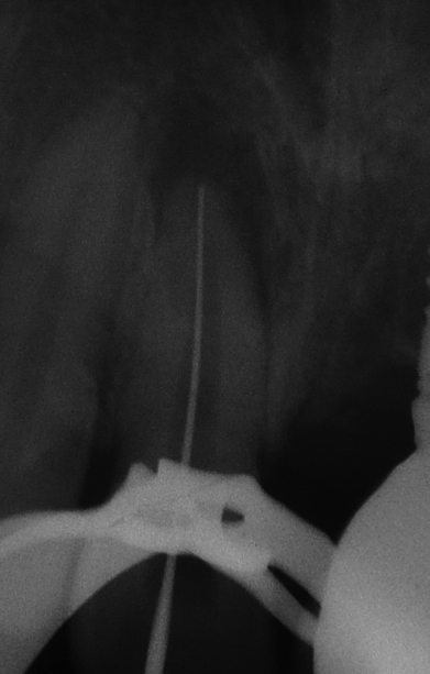 Working Length Radiograph