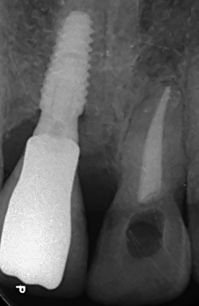 Post-operative radiograph after 2 years.
