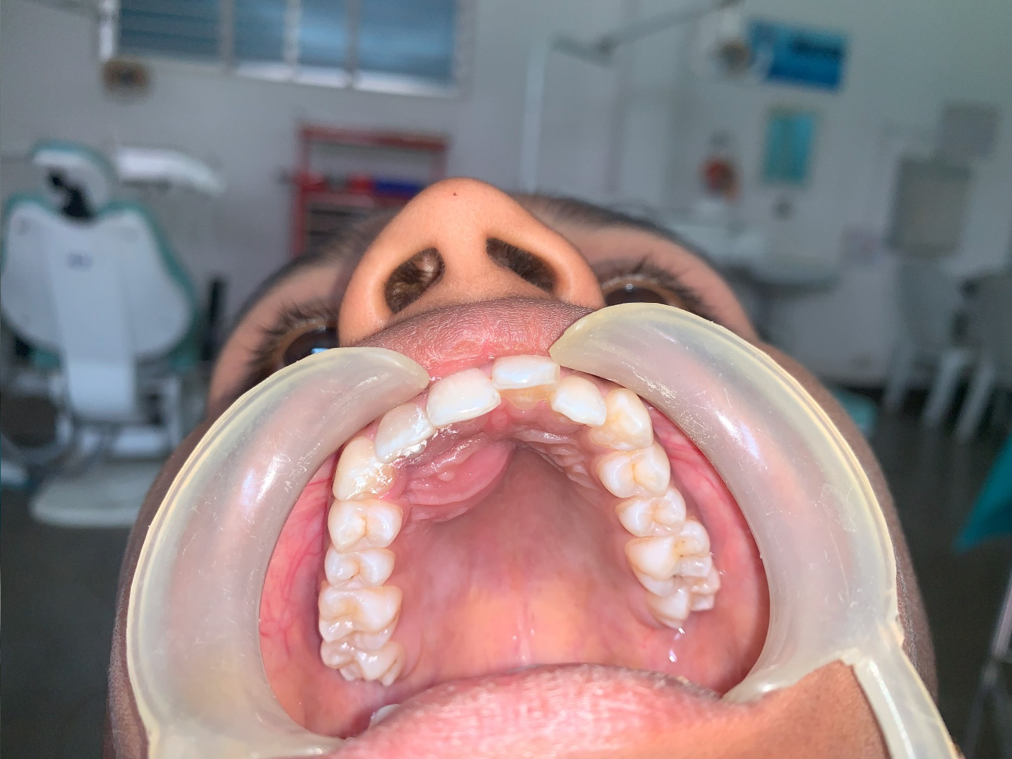 Intra oral examination