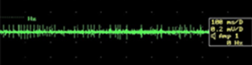 Micro electrode recording of Single neuron activity
