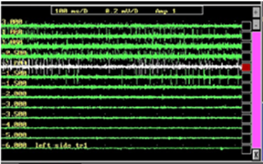 The multi-unit micro electrode recordings of sub thalamic nucleus neurons in the 5-channel electrode across 11mm depicting the usual firing-patterns as well as sporadic-firing followed by the comprehensive and wide-ranging baseline-noise observed from the level -1.00 onwards.