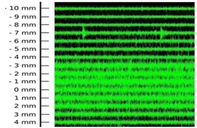 Basic micro electrode recording (MER) of S.T.N`s acquired as of various intensity directly over and above as well as under the object-target.
