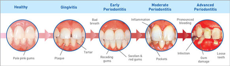 Various phases of periodontal diseases14