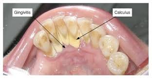 Dental plaque or calculus. Reprinted with permission.33 Copyright 2013. International Journal of Medical Dentistry.