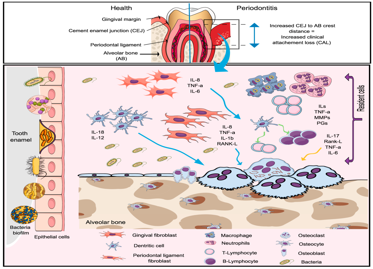 Immune response in periodontal disease. Reprinted with permission from ref.39 Copyright 2017. Journal of Clinical Periodontology.