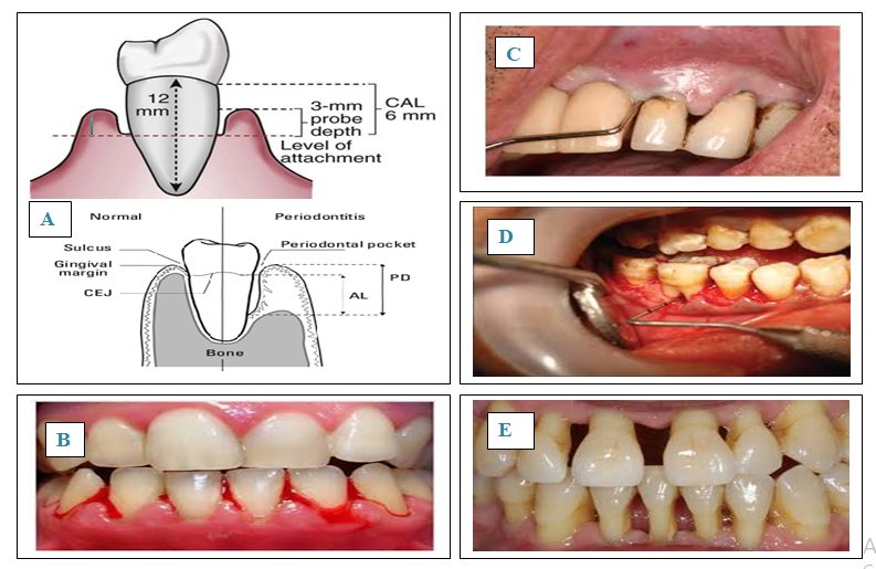 A: Probing depth of periodontal pocket.,42 B: Gingival bleeding.43, C: Suppuration.43, D: Furcation involvement.44 E: Mobility of tooth.44