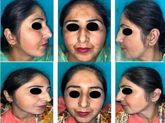 Clinical photographs of 35 year old female withcentrofacial mixed melasma showing significant reduction in mMASI at week 20 in comparison to baseline in Group A.