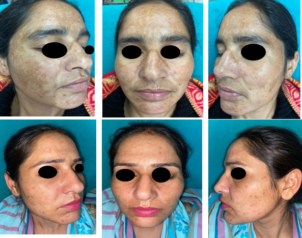 Clinical photographs of 28 year old female with dermalcentrofacial melasma showing significant reduction in mMASI at week 20 in comparison to baseline in group B.