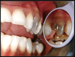 Clinical picture showing grossly decayed and discoloured maxillary left canine #23.
