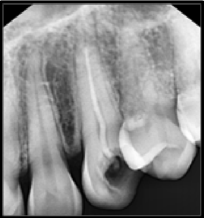 Diagnostic radiograph showingprevious root canal treatment and deficient obturation in the concerned tooth #23.