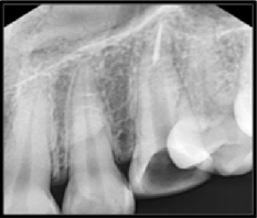 Radiograph showing sectional obturation and post space preparation #23.