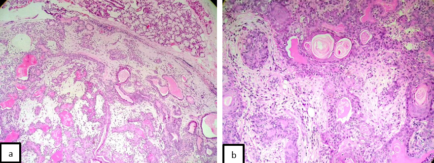 a: Pleomorphic adenoma - benign epithelial elements in a chondromyxoid stroma (x100 H&E) b: Higher magnification shows epithelial elements (x200, H&E)