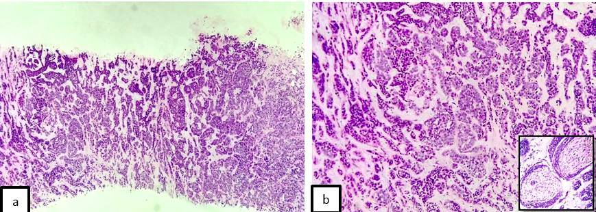 a: Adenoid cystic carcinoma - malignant epithelial cells in infiltrating cords and cribriform pattern (x100 H&E); b: Higher magnification of adenoid cystic carcinoma. Inset - perineural invasion (x200, H&E)