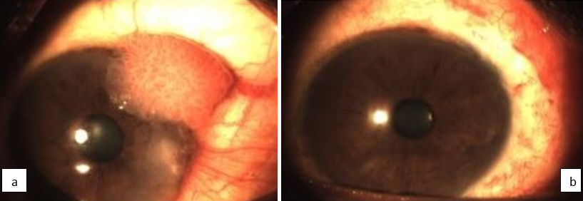 1a: Pre-op OSSN, 1b: Post-op OSSN