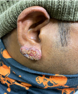 Right ear lobe of the patient showing erythematous and irregular surface with some crustation and oozing, non-tender and indurated lesion.