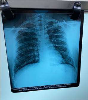 Chest X ray (PA) view of the patient