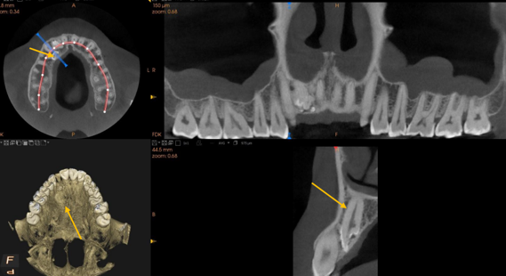 The yellow mark represents the location and morphology of impacted lateral incisor