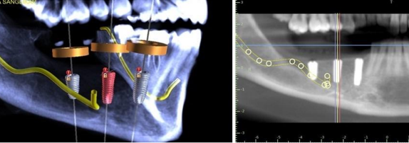 Show the presurgical assessment by using CBCT