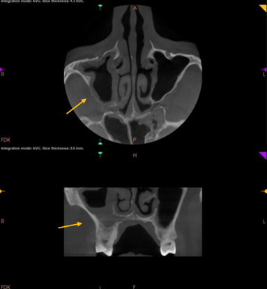 Image showing paranasal sinuses and odontogenic process.
