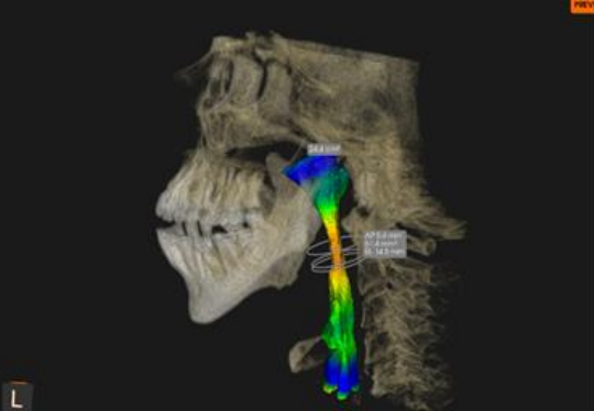 Airway analysis