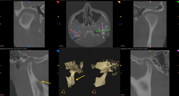 The yellow mark represents sub condylar fracture on right TMJ