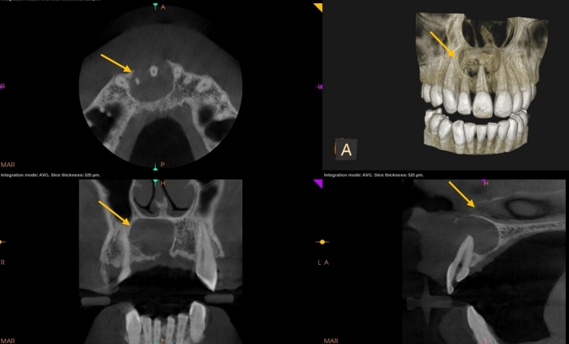 Yellow mark represents the size, shape and extent of the pathology in different sections