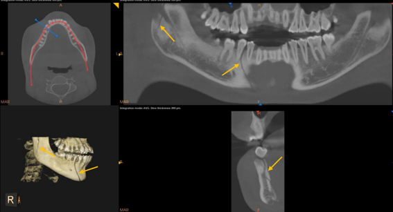 Yellow mark represents the fracture line in different planes of CBCT