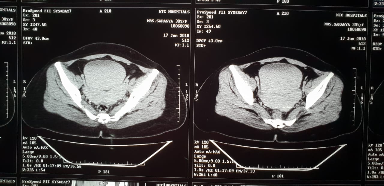 CT image showing bicornuate uterus