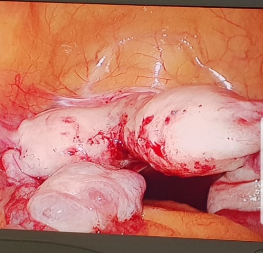Laparoscopic view showing bicornuate uterus with two separate horns and tubes