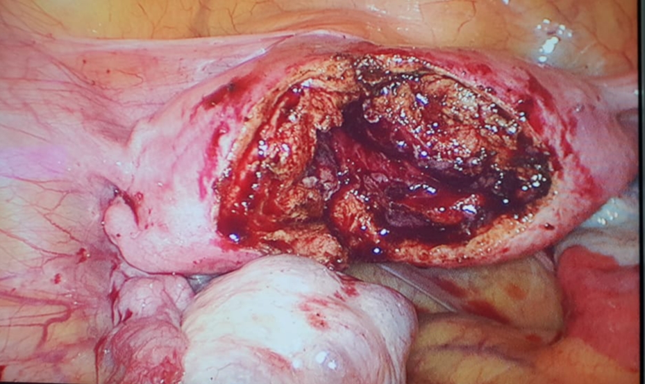 Opened horns showing myometrium and endometrium