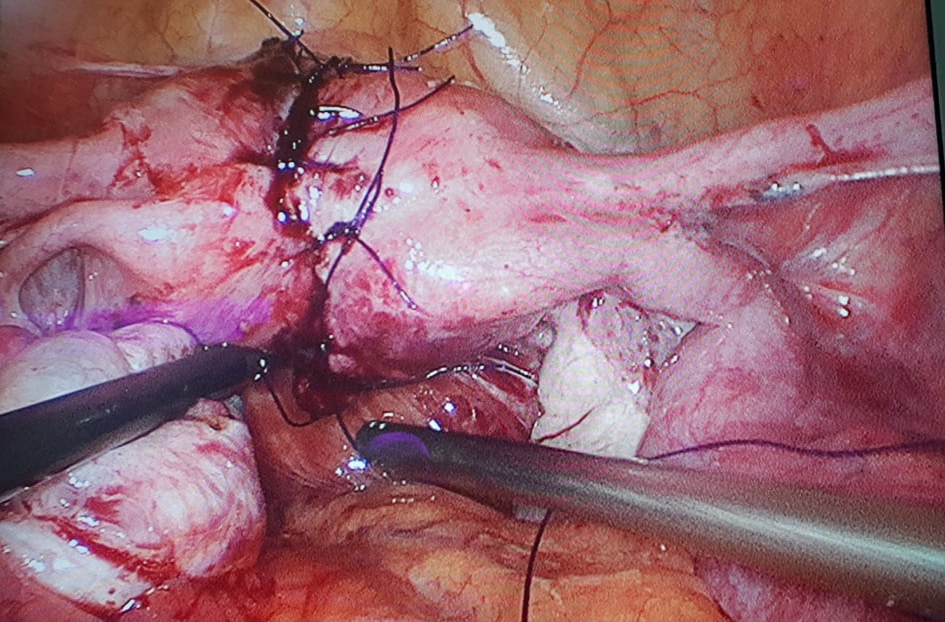 Interrupted sutures using PDS in second layer