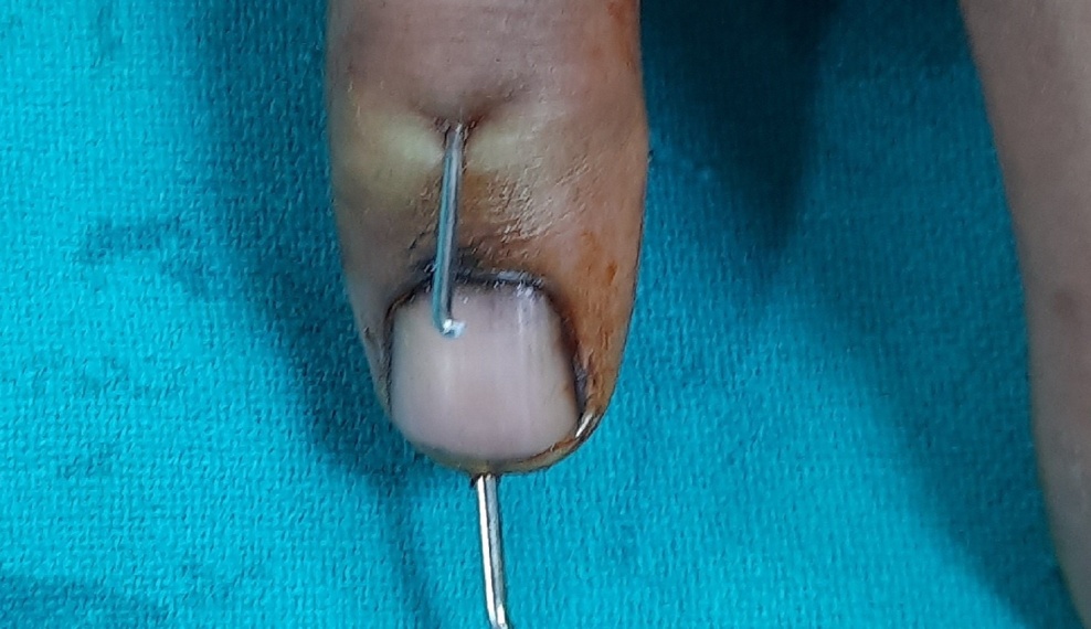 Extension block pinning for mallet fingerA case series of 15 cases IJOS