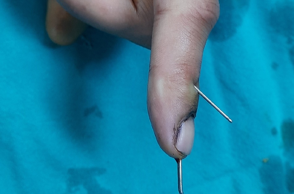 Extension block pinning for mallet fingerA case series of 15 cases IJOS