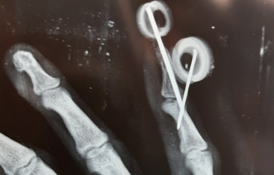 Extension block pinning for mallet fingerA case series of 15 cases IJOS