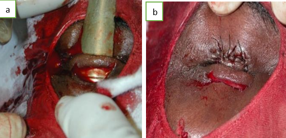 a and b: Intraoperative pictures of Cutler-Beard Technique