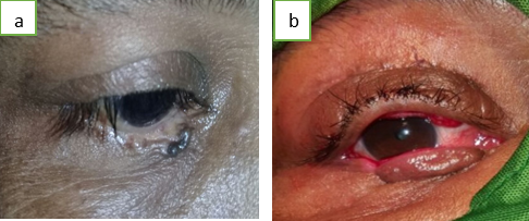 a: Squamous cell carcinoma of lower lid before lid reconstruction; b: After lid reconstruction with Hughes flap reconstruction.
